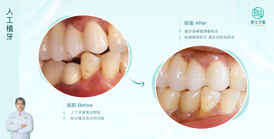 精準咬合，重塑⾃信微笑